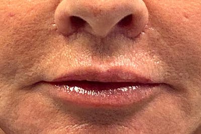 Lip Lift Before & After Gallery - Patient 282384 - Image 2