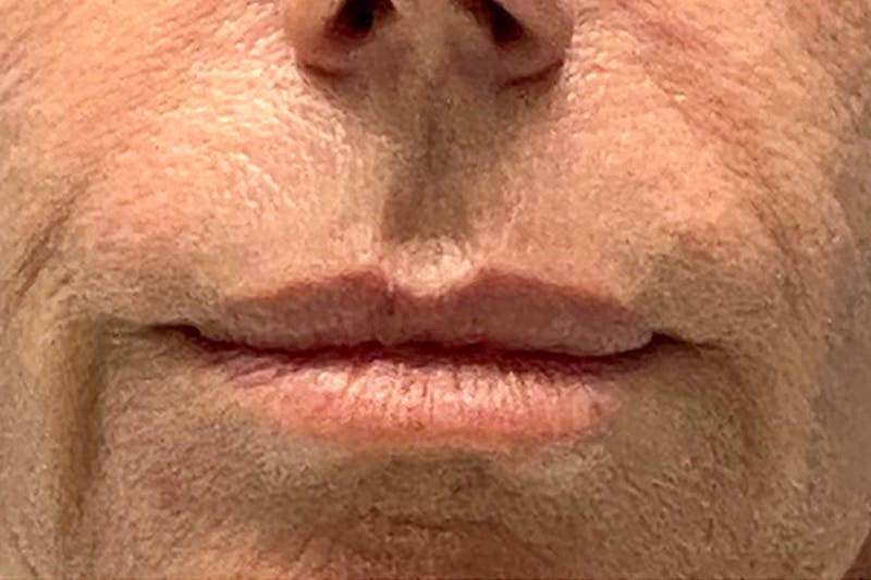 Lip Lift Before & After Gallery - Patient 135781 - Image 1