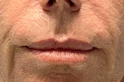 Lip Lift Before & After Gallery - Patient 135781 - Image 1