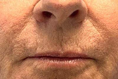 Lip Lift Before & After Gallery - Patient 282384 - Image 1