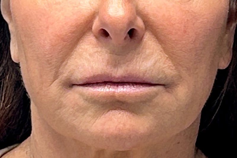 Lip Lift Before & After Gallery - Patient 190265 - Image 1