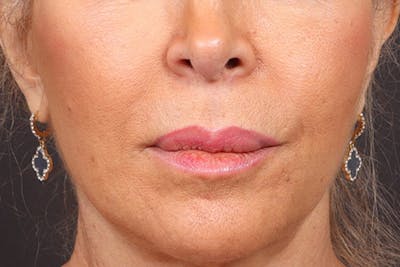 Lip Lift Before & After Gallery - Patient 198845 - Image 1