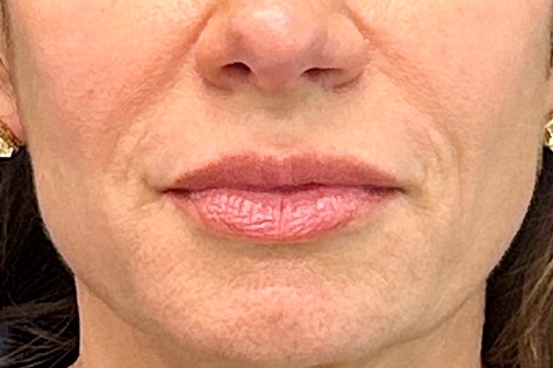 Lip Lift Before & After Gallery - Patient 247443 - Image 1