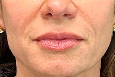 Lip Lift Before & After Gallery - Patient 247443 - Image 1