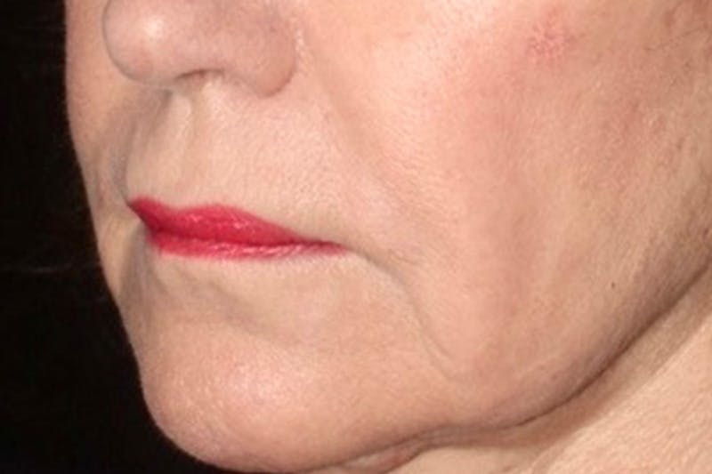 Lip Lift Before & After Gallery - Patient 221162 - Image 3