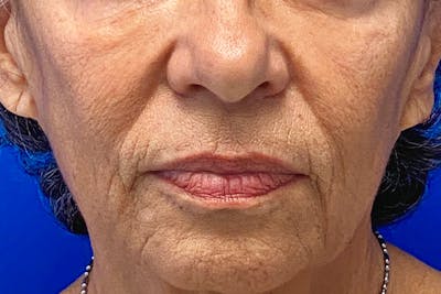 Lip Lift Before & After Gallery - Patient 371532 - Image 1