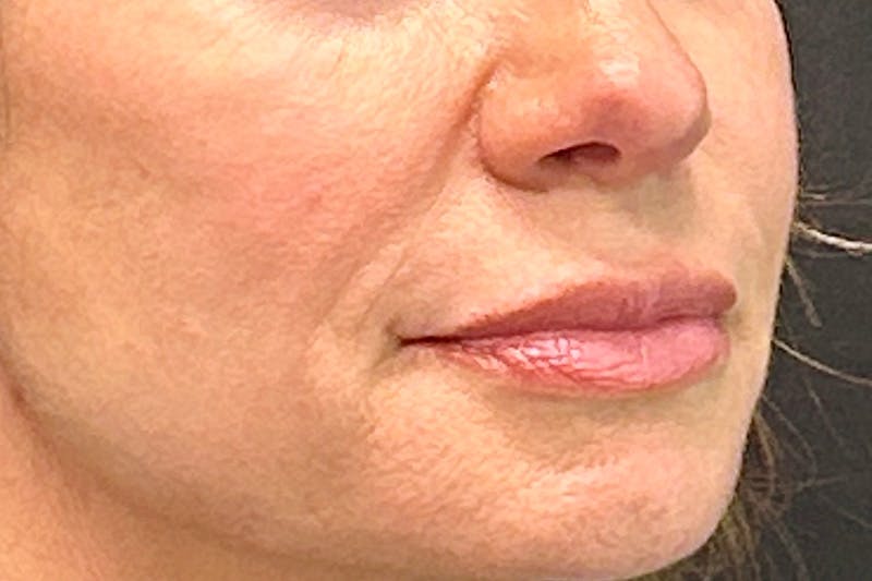 Lip Lift Before & After Gallery - Patient 247443 - Image 3