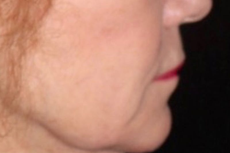 Lip Lift Before & After Gallery - Patient 221162 - Image 5