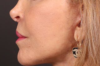 Lip Lift Before & After Gallery - Patient 198845 - Image 6