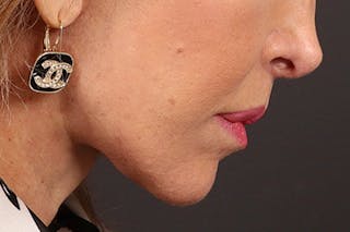 Lip Lift Before & After Gallery - Patient 198845 - Image 8