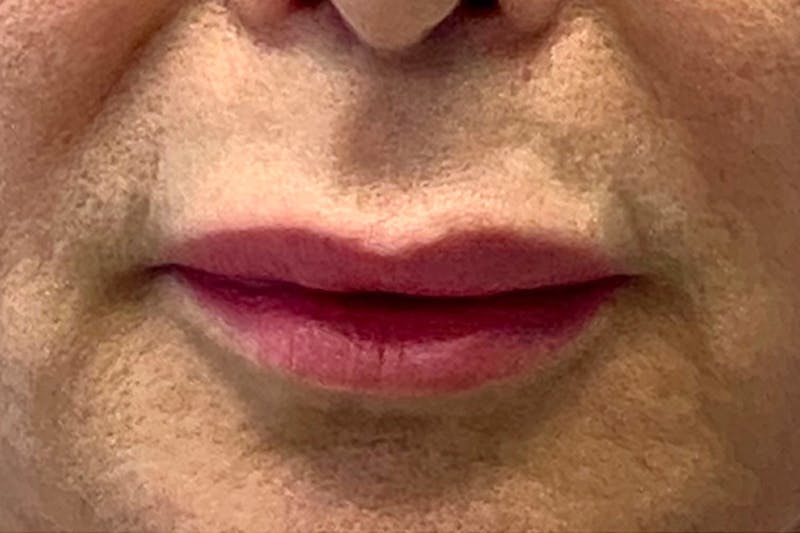 Lip Lift Before & After Gallery - Patient 148238 - Image 1