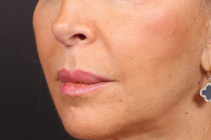 Lip Lift Before & After Gallery - Patient 198845 - Image 3