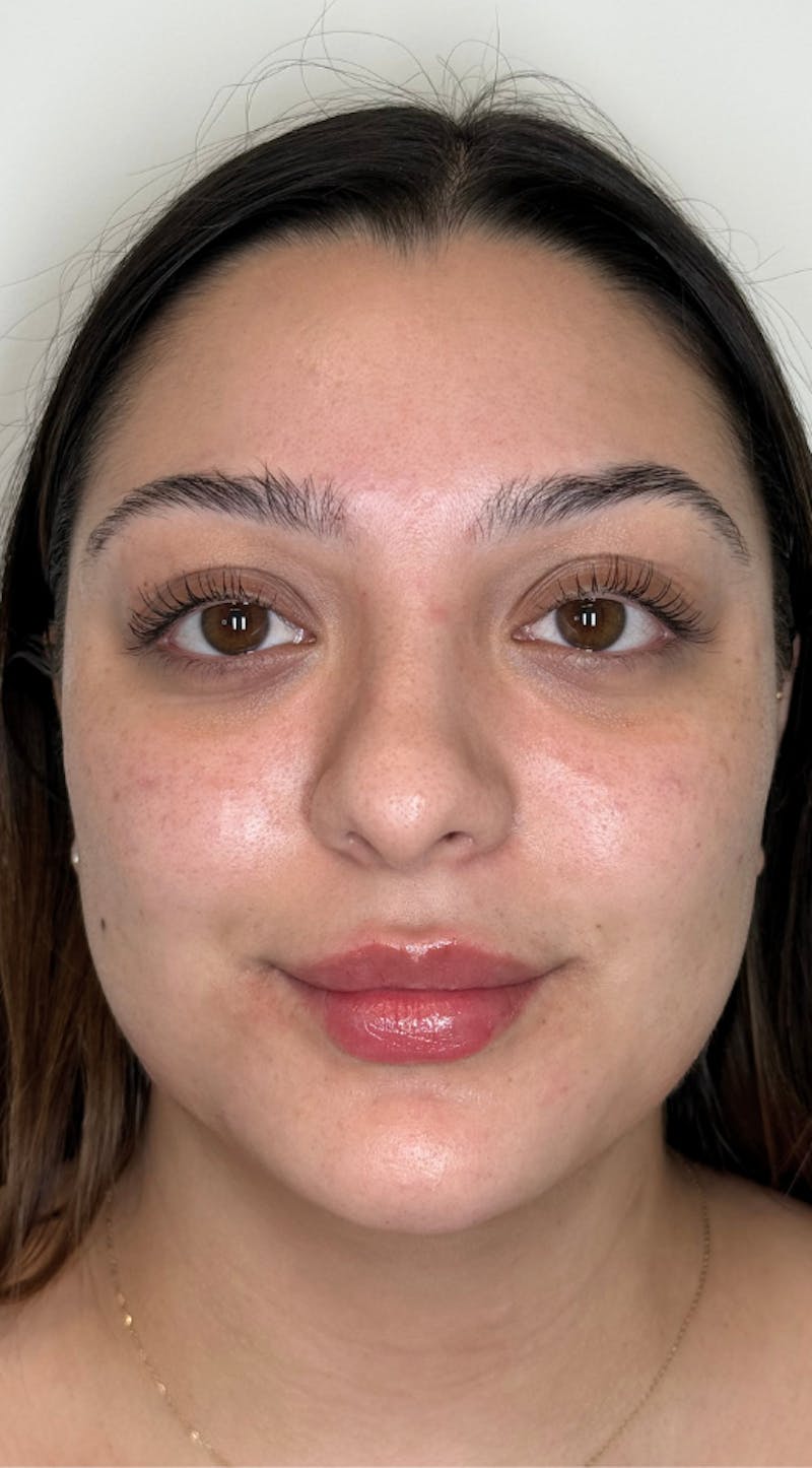 Facial Balancing Before & After Gallery - Patient 286618 - Image 4