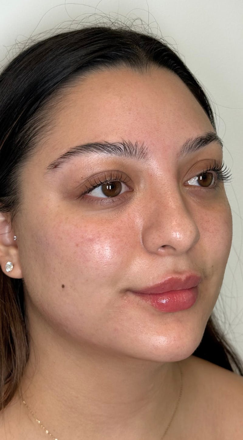 Facial Balancing Before & After Gallery - Patient 286618 - Image 2