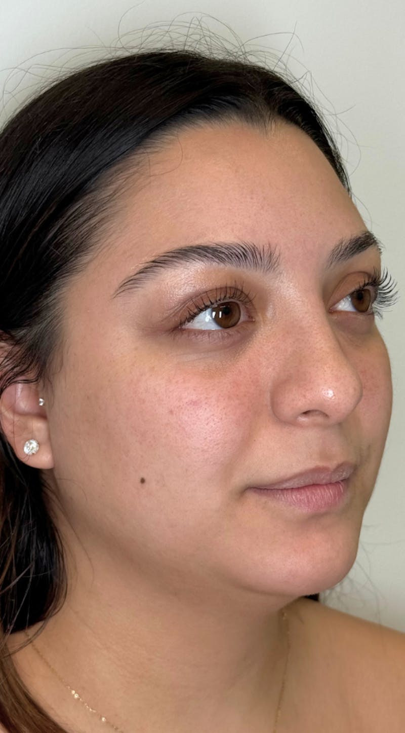 Facial Balancing Before & After Gallery - Patient 286618 - Image 1