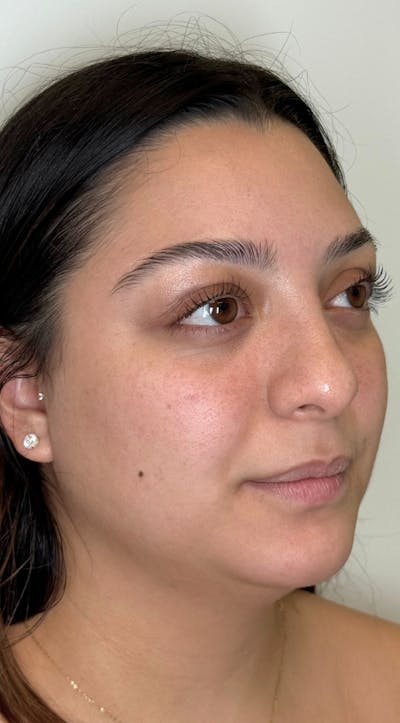 Facial Balancing Before & After Gallery - Patient 286618 - Image 1
