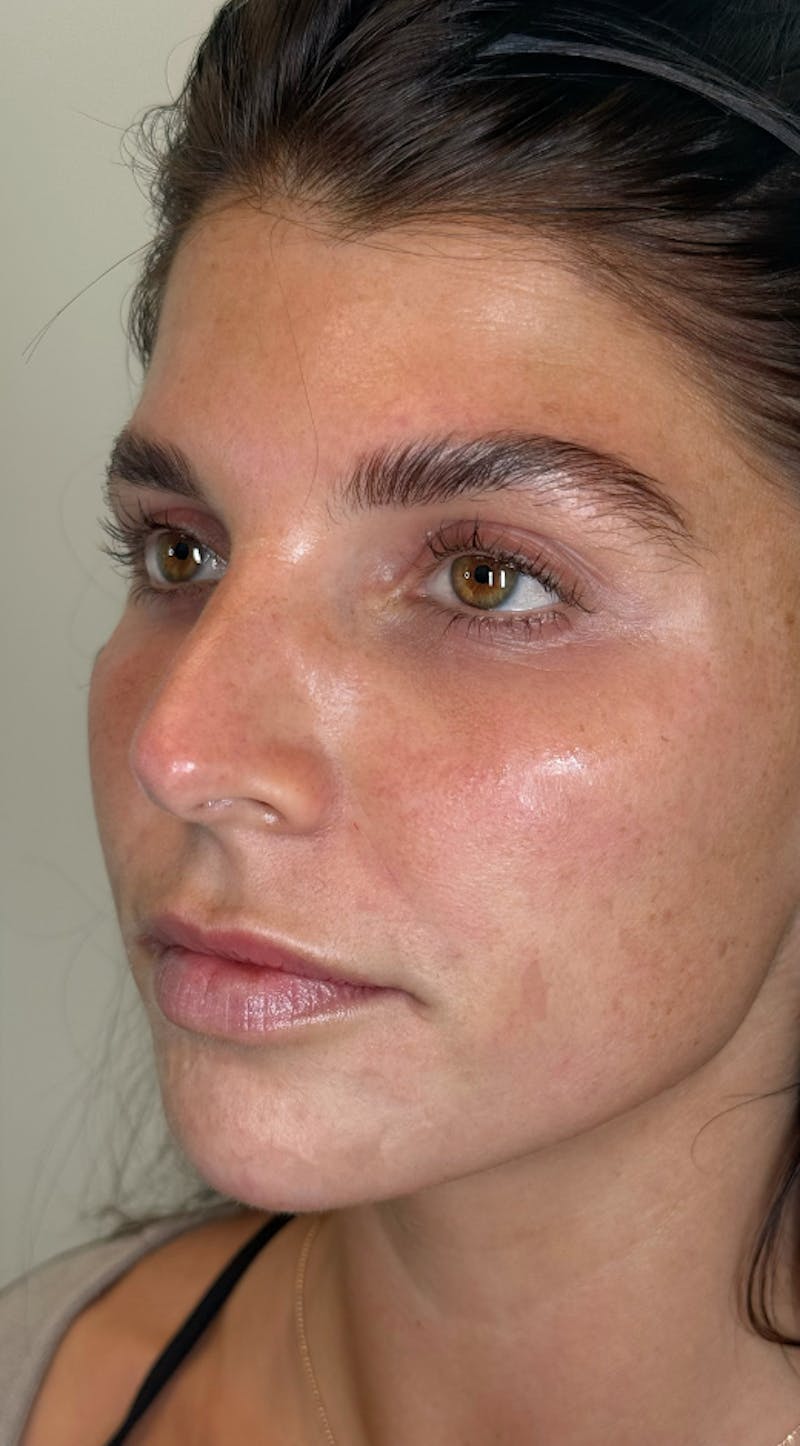 Facial Balancing Before & After Gallery - Patient 395518 - Image 2
