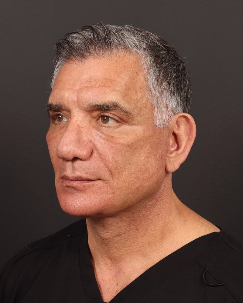 Facelift Before & After Gallery - Patient 162346 - Image 4