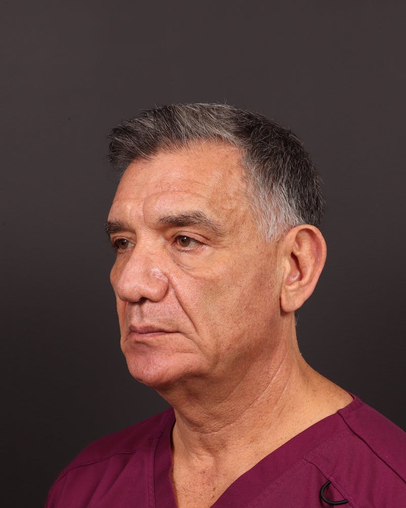 Facelift Before & After Gallery - Patient 162346 - Image 5