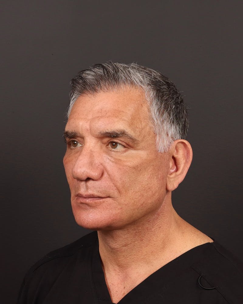 Facelift Before & After Gallery - Patient 162346 - Image 6