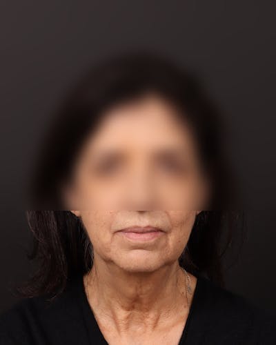 Facelift Before & After Gallery - Patient 142023 - Image 1