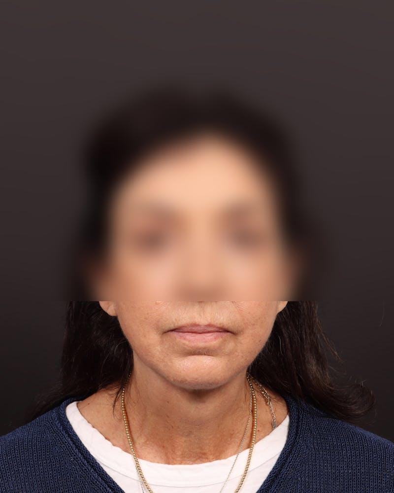 Facelift Before & After Gallery - Patient 142023 - Image 2