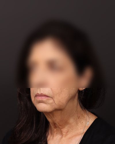 Neck Lift Before & After Gallery - Patient 127037 - Image 1