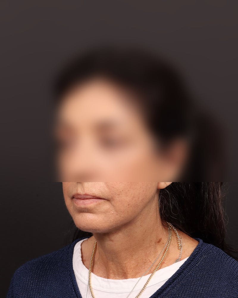 Facelift Before & After Gallery - Patient 142023 - Image 4