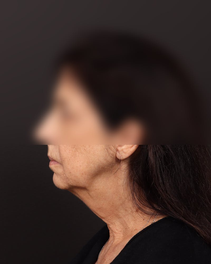 Facelift Before & After Gallery - Patient 142023 - Image 5