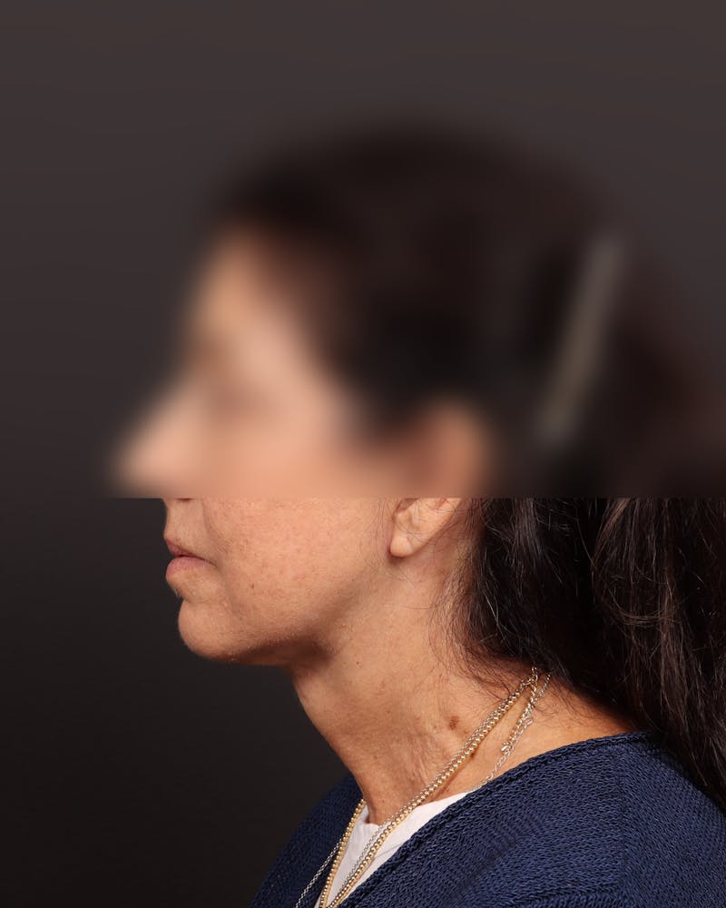 Facelift Before & After Gallery - Patient 142023 - Image 6