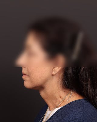Facelift Before & After Gallery - Patient 142023 - Image 6