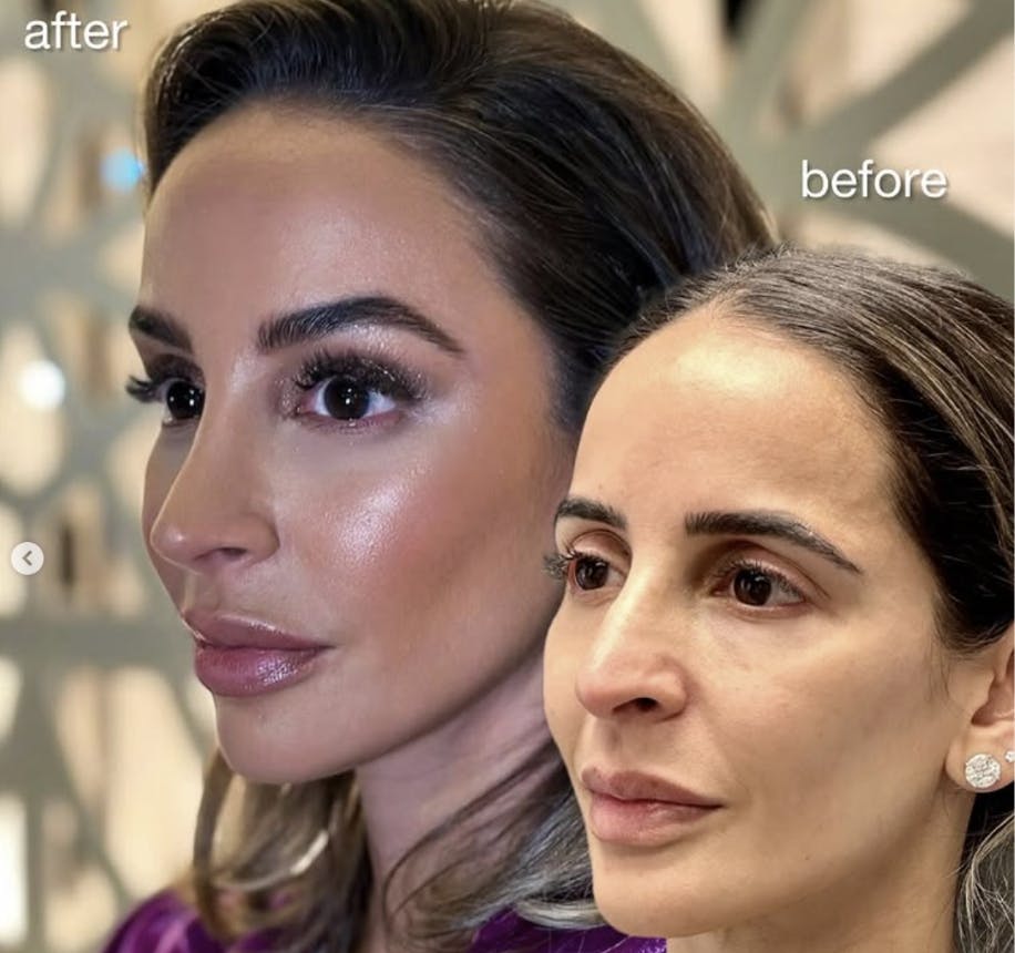 woman's brow lift results
