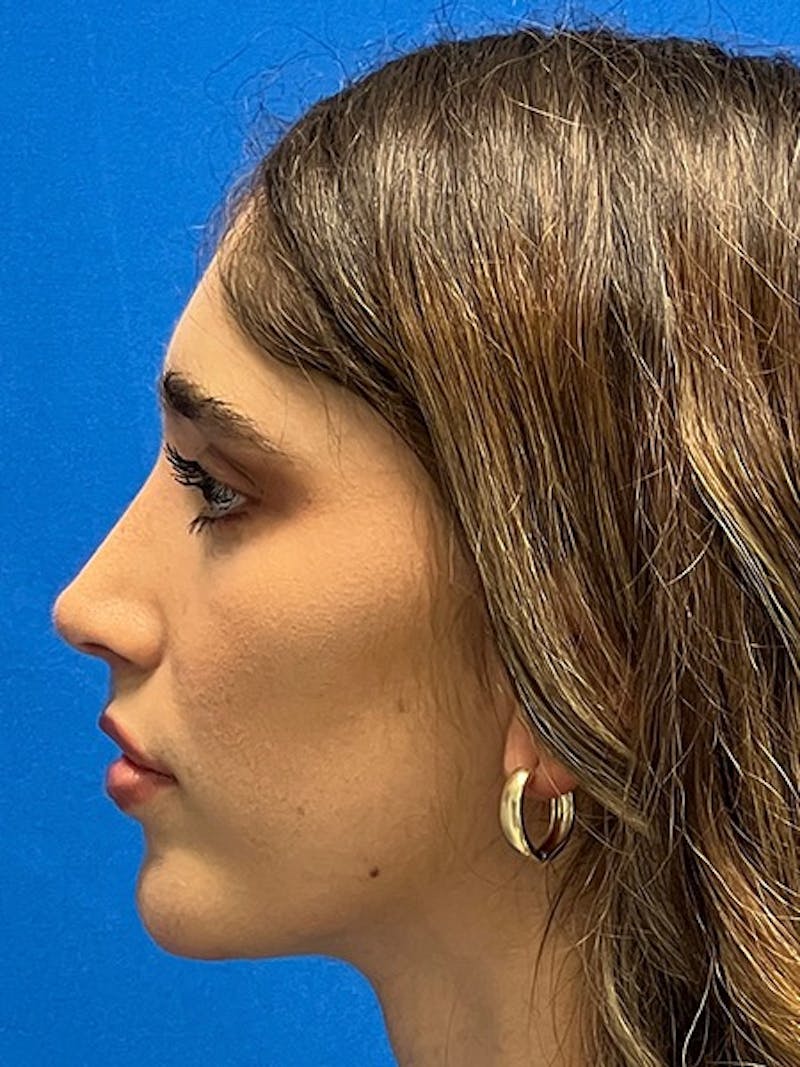 Primary Rhinoplasty Before & After Gallery - Patient 342098 - Image 2