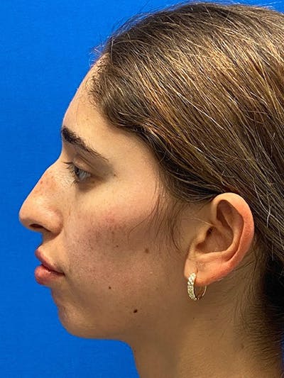 Primary Rhinoplasty Before & After Gallery - Patient 342098 - Image 1