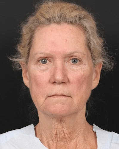 Brow Lift Before & After Gallery - Patient 196828 - Image 1