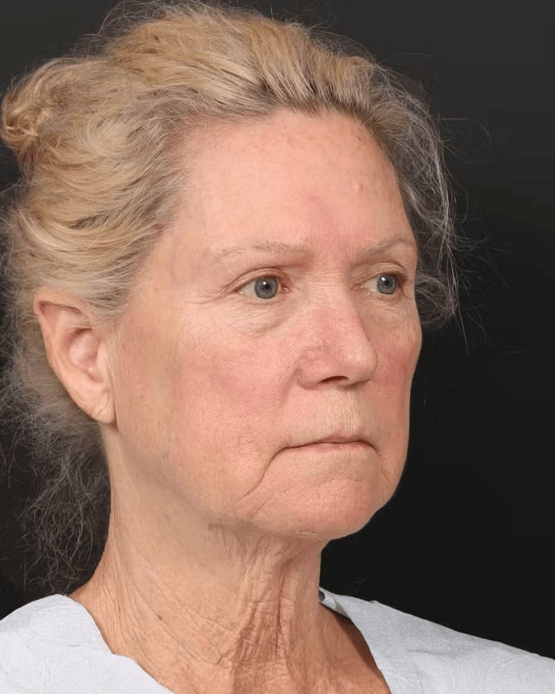 Brow Lift Before & After Gallery - Patient 196828 - Image 3