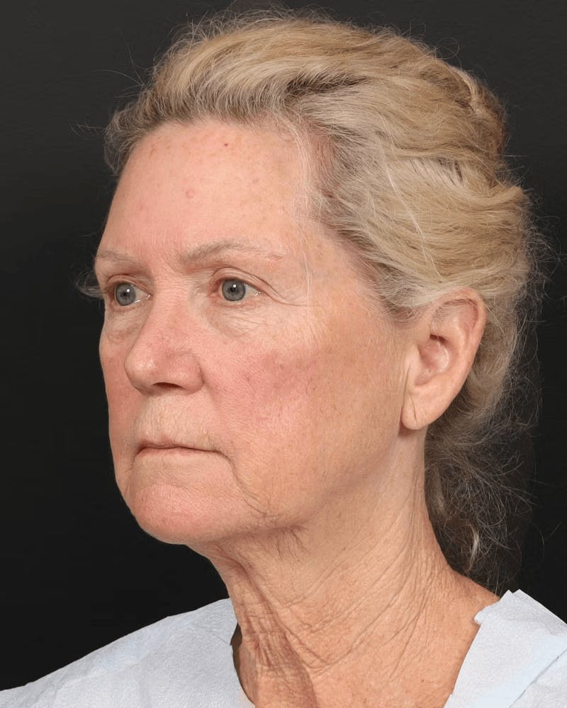 Brow Lift Before & After Gallery - Patient 196828 - Image 7