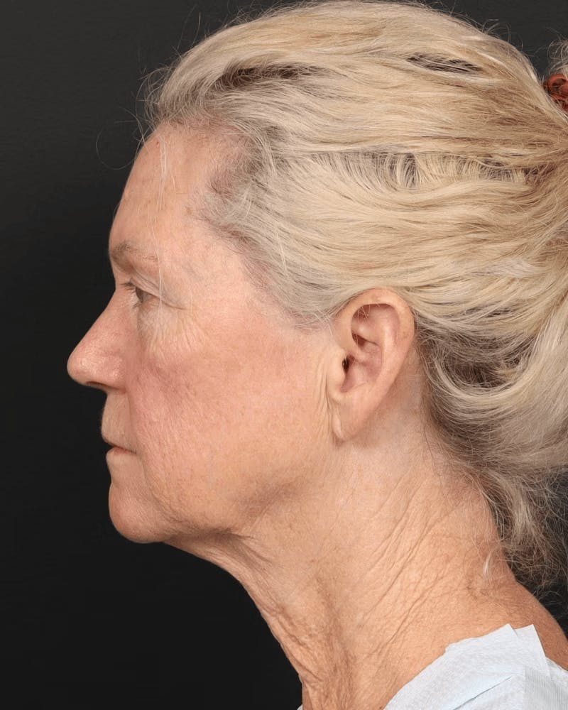 Brow Lift Before & After Gallery - Patient 196828 - Image 10