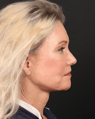 Brow Lift Before & After Gallery - Patient 196828 - Image 6