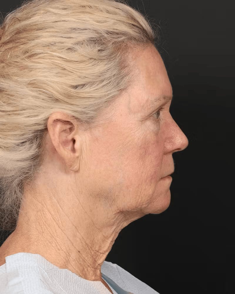 Brow Lift Before & After Gallery - Patient 196828 - Image 5