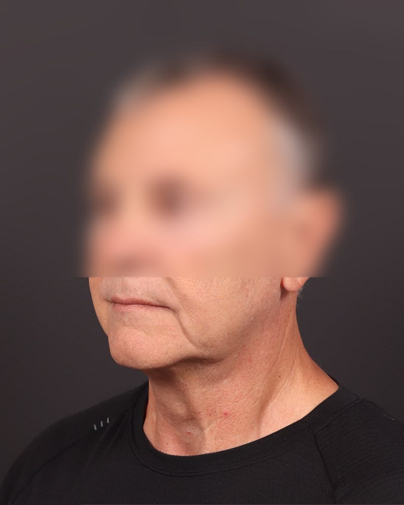 Male Face & Neck Before & After Gallery - Patient 172959 - Image 3