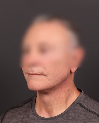 Neck Lift Before & After Gallery - Patient 230912 - Image 2