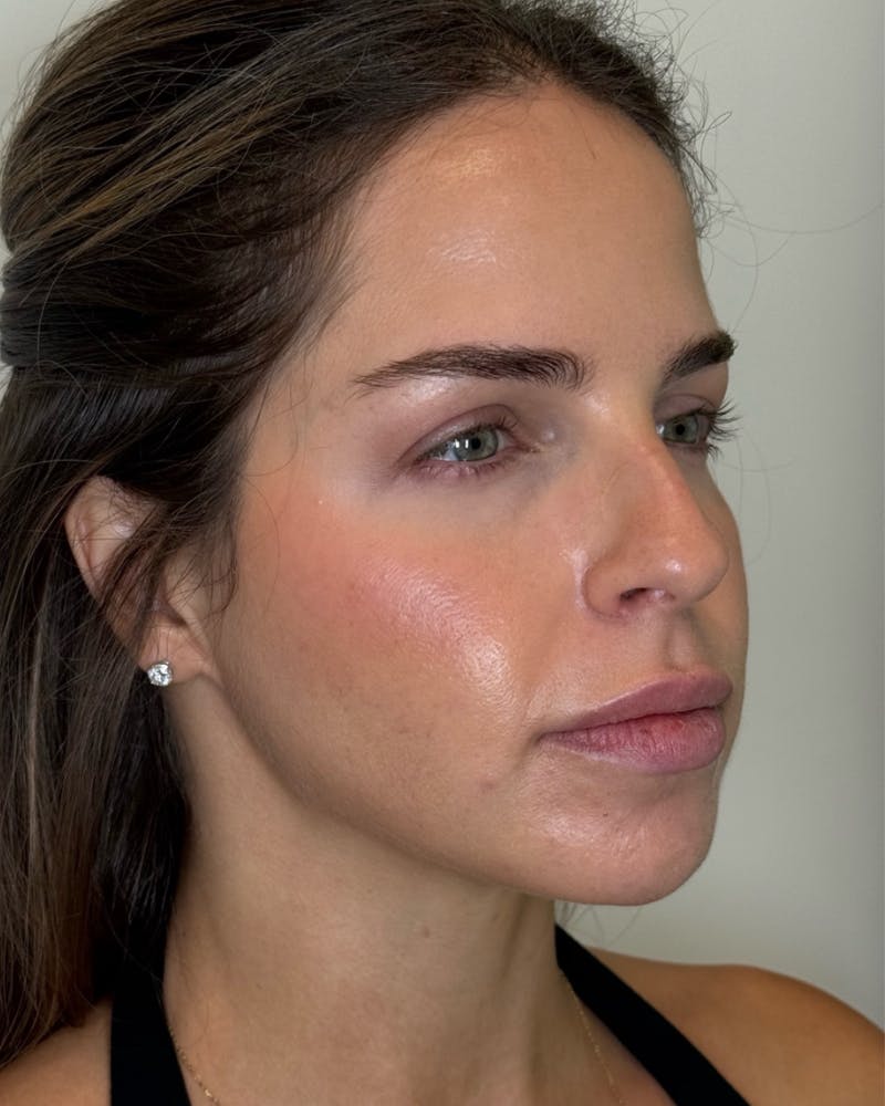 Nefertiti Neck Lift Before & After Gallery - Patient 355118 - Image 2