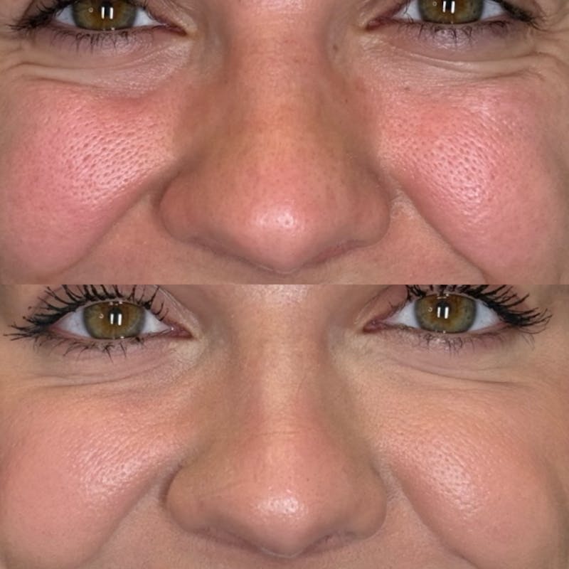 Facial Balancing Before & After Gallery - Patient 162636 - Image 3