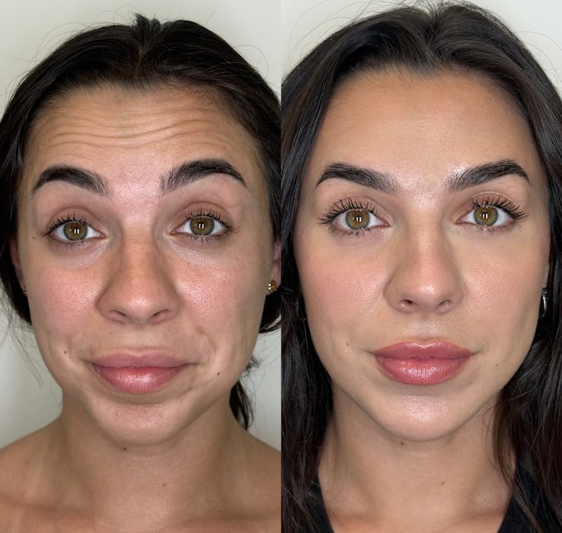 Facial Balancing Before & After Gallery - Patient 162636 - Image 1