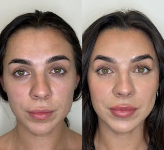 Facial Balancing Before & After Gallery - Patient 162636 - Image 2
