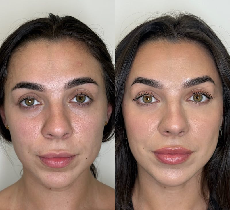 Facial Balancing Before & After Gallery - Patient 162636 - Image 2