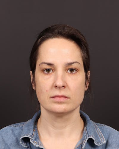 Blepharoplasty Before & After Gallery - Patient 355296 - Image 1