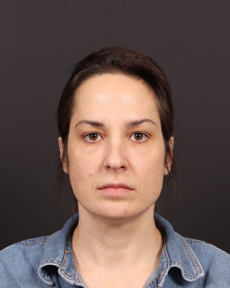Blepharoplasty Before & After Gallery - Patient 355296 - Image 1