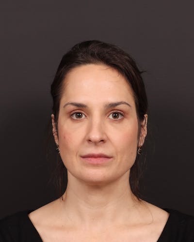 Blepharoplasty Before & After Gallery - Patient 355296 - Image 2